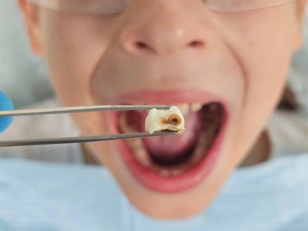 Best Emergency Tooth Extraction in Shallowater, TX